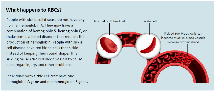 Illustration comparing normal red blood cells and sickle-shaped cells associated with sickle cell disease. The left side shows a normal red blood cell, while the right side features sickle cells stuck in a blood vessel. The image includes a brief explanatory text about the impact of sickle cell disease on individuals.
